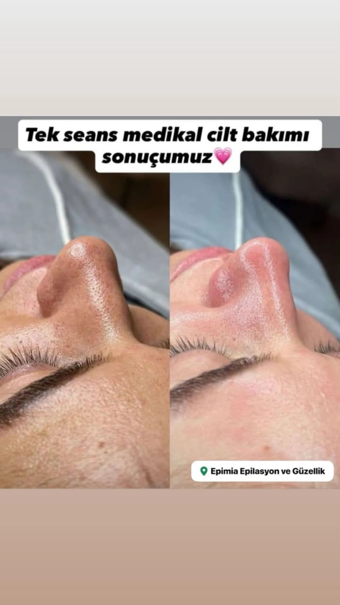 Tek Seans Cilt Bakımı Sonucu